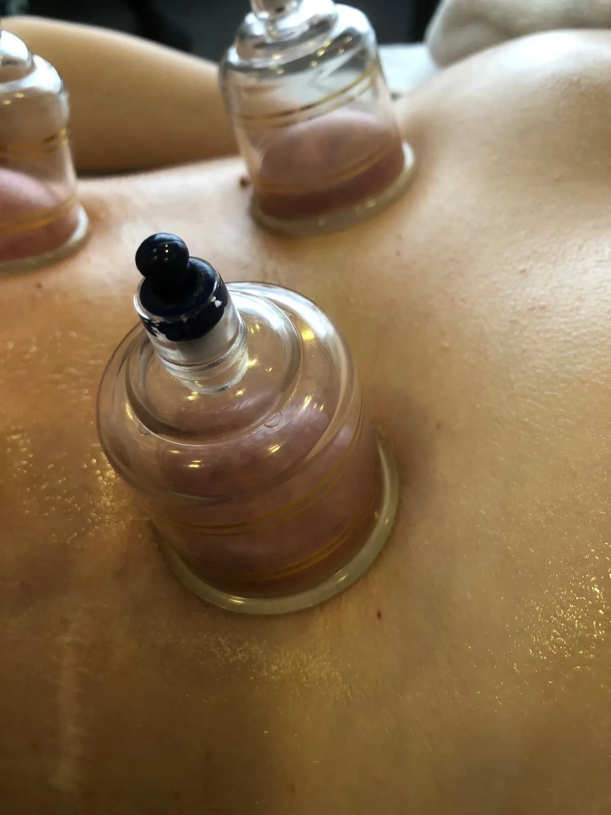 Cupping — postavljanje čašica (profil)