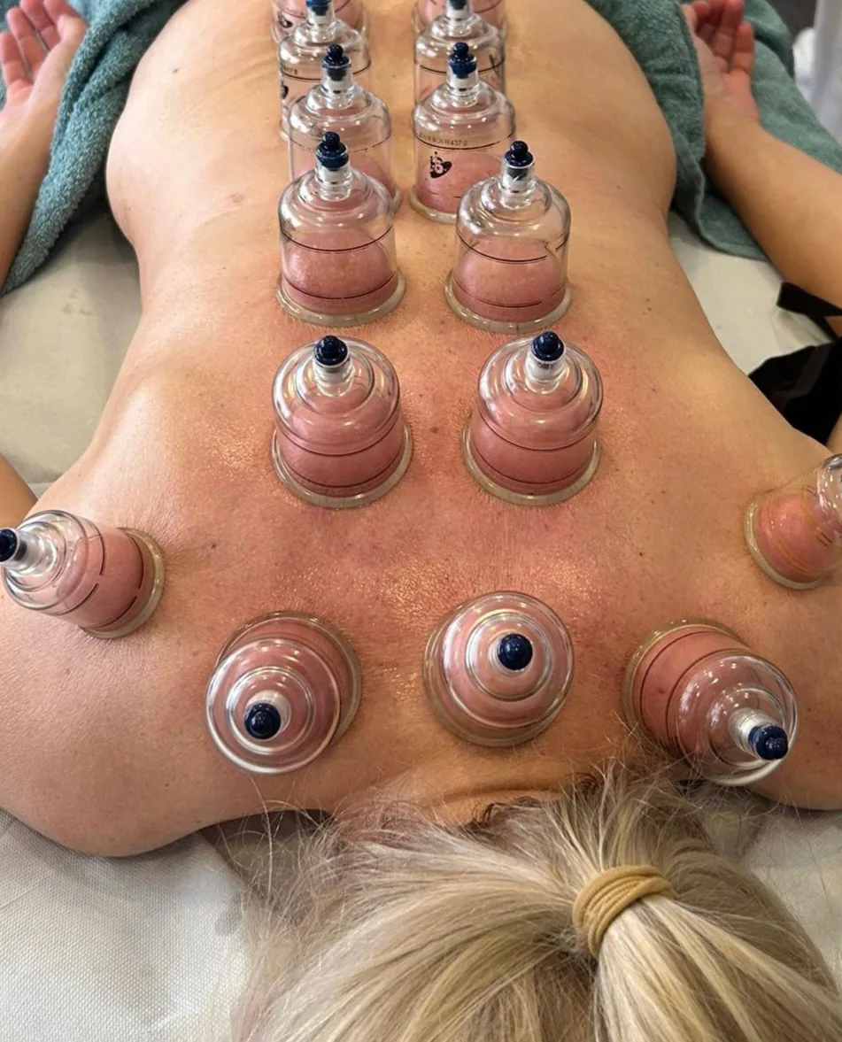 Cupping — leđa s više čašica
